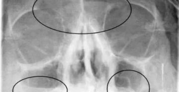 На рентгеновском снимке гайморит, а симптомов нет