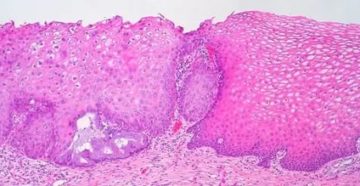 Койлоцитарная дистрофия, ВПЧ