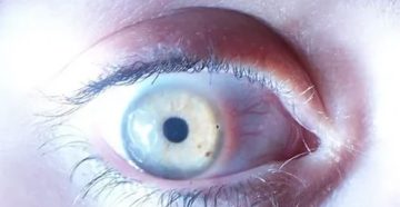 Попала белизна в глаз
