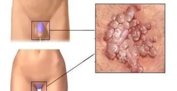 Мозоль возле половой губы