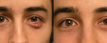 После удаления халязиона опустилось веко