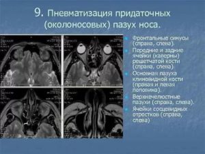 Что означает пневматизация пазух достаточная