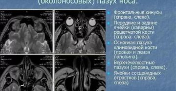 Что означает пневматизация пазух достаточная