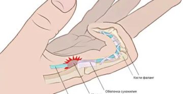 Боль при сгибании указательного пальца