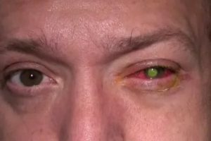 Боль в глазу после операции катаракты