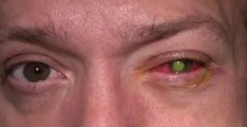 Боль в глазу после операции катаракты