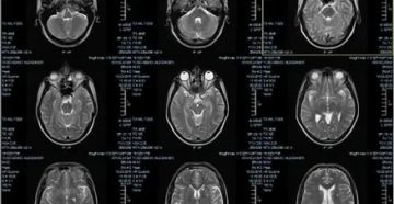 МРТ-расшифровка МРТ-расшифровка