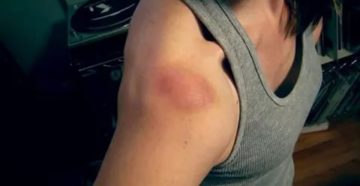 Всд, синяки на теле Всд, синяки на теле