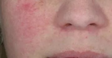 Пятно на щеке. Зудит Пятно на щеке. Зудит