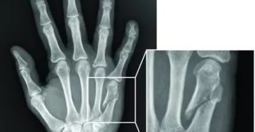 Подголовчатый перелом 5 пястной кости
