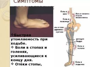 Хруст при ходьбе нижней части ноги в области стопы