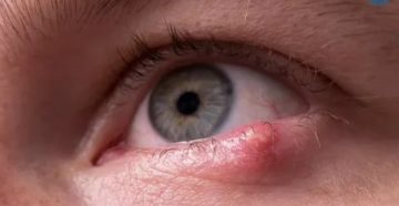 Застарелый ячмень.