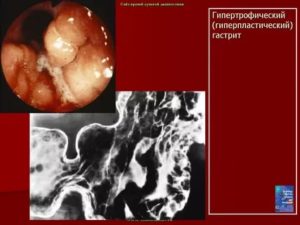 Недостаточность кардии, гастрита, дуоденита
