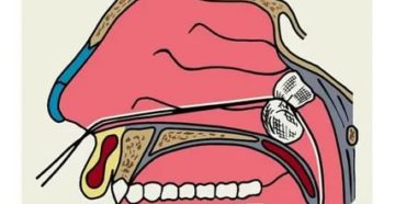 Частые носовые кровотечения на протяжении 2 лет после аденотомии? Частые носовые кровотечения на протяжении 2 лет после аденотомии?
