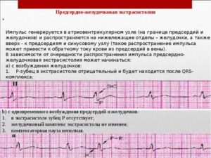 Желудочковая экстрасистолия, низкий пульс