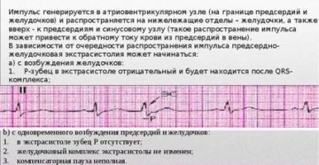 Желудочковая экстрасистолия, низкий пульс