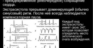 Экстрасистолия после РЧА сердца