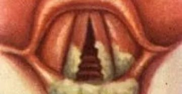 В горле пленка