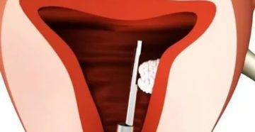 Боли в матке при ходьбе