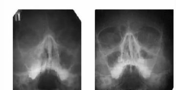 Затемнение в пазухе носа