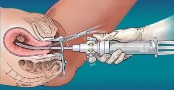 Боли после вакуум аспирации