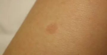 Пятна на руке Коричневого и красного цвета