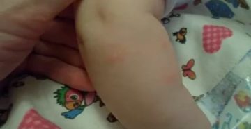 Пятна на руках у ребенка