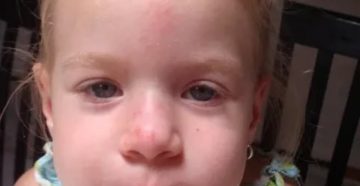 Ушиб носа у ребенка 2.5 лет