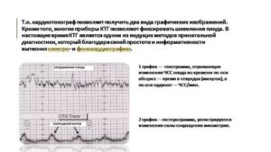 Расшифровка КТГ, маточные сокращения