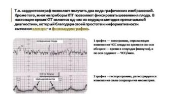 Расшифровка КТГ, маточные сокращения