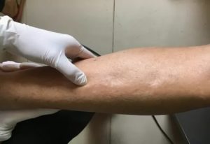 Припухлость на голени