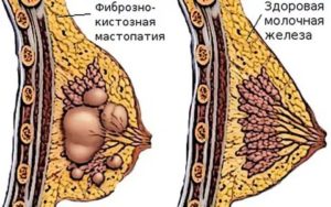 Фиброаденома, ФКМ, выделения из груди
