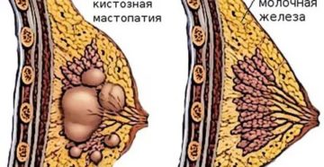 Фиброаденома, ФКМ, выделения из груди