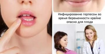 Герпес в носу при беременности