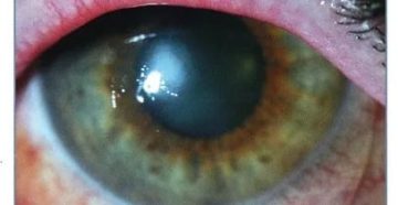 Посттравматическая эрозия роговицы