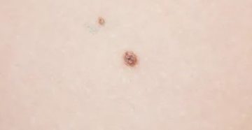 Странная родинка, выпуклая, точка посередине