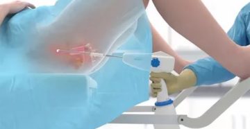 Лечение после прижигания эрозии