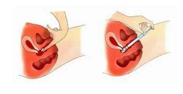Можно ли вводить одновременно во влагалище свечи галавит и йодоксид?