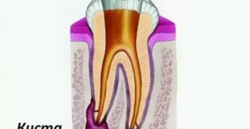 Киста на корне зуба и беременность