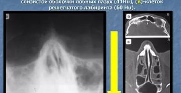 Негомогенное содержимое основной пазухи Негомогенное содержимое основной пазухи