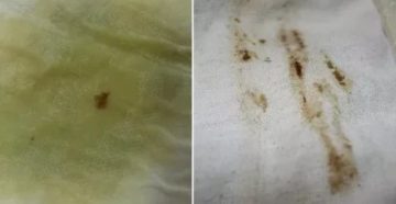 Коричневые выделения после отслойки