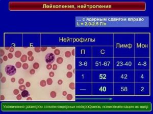 Лейкопения, нейтропения
