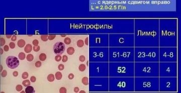 Лейкопения, нейтропения
