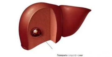 Массаж при гемангиоме печени