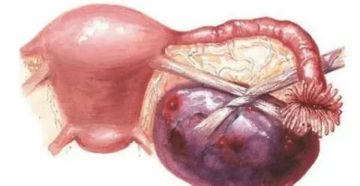 Киста яичника. Жжение внизу живота