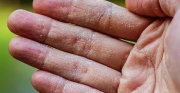 Сухие ладони. Белый налёт