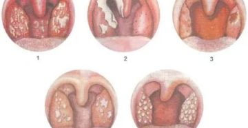 Бляшки на миндалинах