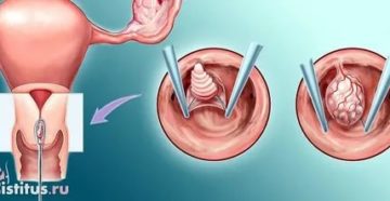 Полип в цервикальном канале
