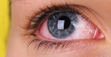 Воспаление после линзы Воспаление после линзы