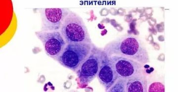 Метаплазированные клетки - что это и опасно ли?